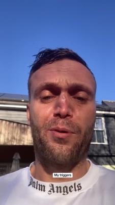 Šejn Samler je upropastio nos od prekomerne konzumacije kokaina