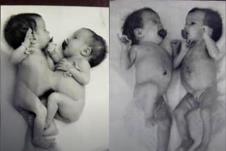 Sijamske bliznakinje Ana i Tanja Korkinova kao bebe.jpg