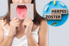 devojka drži ispred lica slikovni prikaz ranica na jeziku/herpes zoster ispis