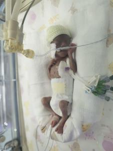 Kruna prevremeno rođena beba u inkubatoru