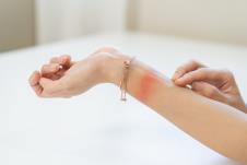 crvenilo na ruci od narukvice