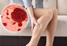 žena koja se drži za bolan list/ tromb