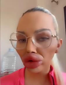 Vijena Vurstel ima najveće usne na svetu