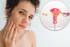 žena sa aknama po licu/maketa vulve