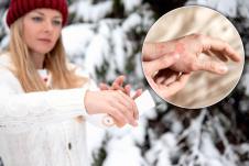 žena maže kremu zimi/ekcem