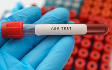 ruka laboranta drži epruvetu sa natpisom CRP test