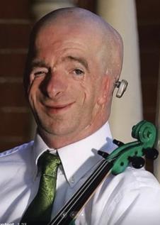 Frensis Džoel Smit - rođen sa Tričer Kolins sindromom