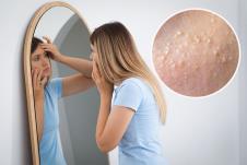 devojka u plavoj majci stoji ispred velikog ogledala i gleda kožu lica/milije male, bele izbočine na koži