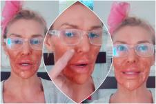 Brendi Glenvil sa ranama po licu