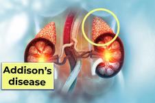 crtež bubrega sa nadbubrežnim žlezdama, natpis Adisonova bolest