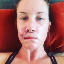 Kori Felc - probudila se tokom operacije raka kože na usni