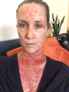 Kori Felc - probudila se tokom operacije raka kože na usni