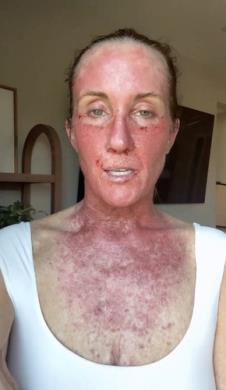 Kori Felc - probudila se tokom operacije raka kože na usni