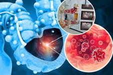 Rak debelog creva grafički prikaz/maketa sa snimcima skenera