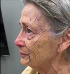 Žena pre fejsliftinga sa drastičnom promenom izgleda (4).png