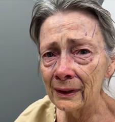 Žena pre fejsliftinga sa drastičnom promenom izgleda (5).png