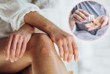 nova terapija za psorijazu u obliku pilule