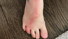 Majka je uočila da njen sin ima limfangitis, infekciju koja može da bude veoma opasna