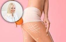 dr Jasmina Vikalo/noge mlade žene zahvaćene celulitom