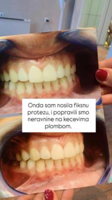 Edita Aradinović o estetskim zahvatima