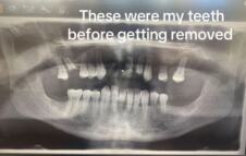 Džon Denton ostao bez zuba u Turskoj (2).png