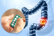 grafički prikaz raka debelog creva/aspirin