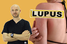 lupus, koža, dr Ivica Jeremić