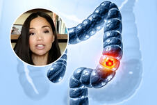 Marija Kang rak debelog creva