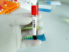 Medicinski radnik drži test koji proverava A/G odnos