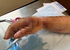 Piter Marfi umalo ostao bez ruke nakon ujeda pauka
