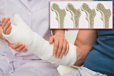 osteoartritis koštana masa padovi