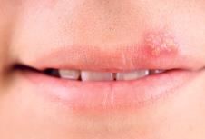herpes-zoster.jpg