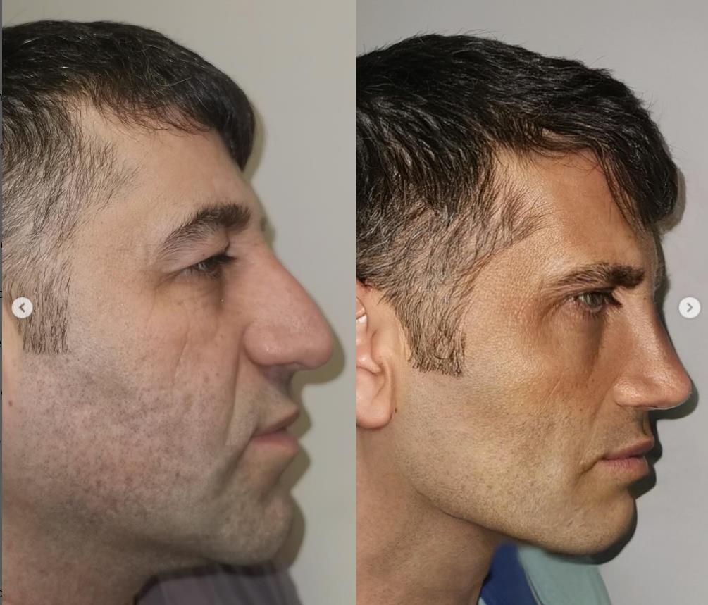 Muškarac pre i posle estetskih operacija lica – potpuno drugačiji izgled nakon osam meseci tretmana u Turskoj.