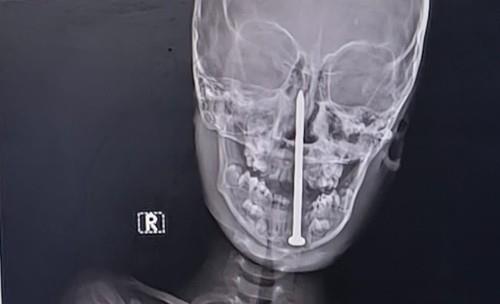 dečak ekser profimedia-1005204043.jpg