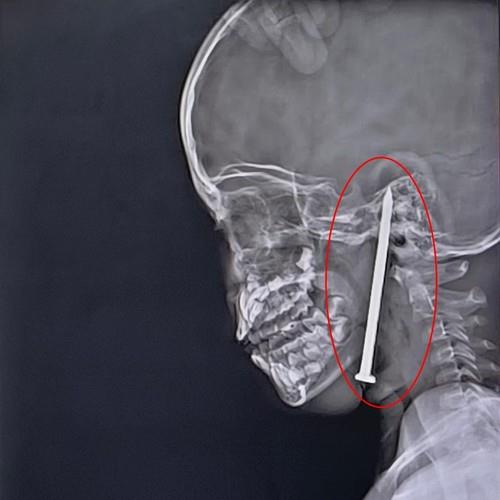 dečak ekser profimedia-1005203967.jpg