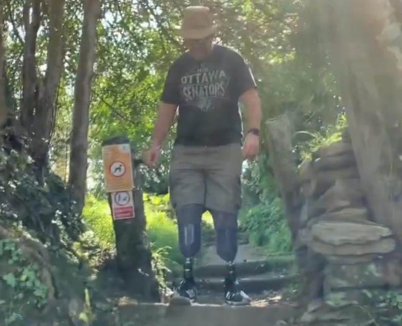 Vaskularni hirurg optužen da je sam sebi odsekao noge