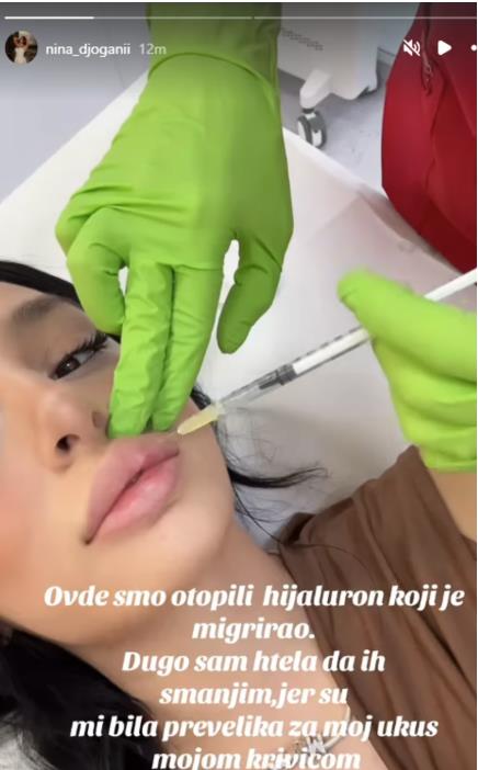 Nina Đogani pokazala proces smanjivanja usana
