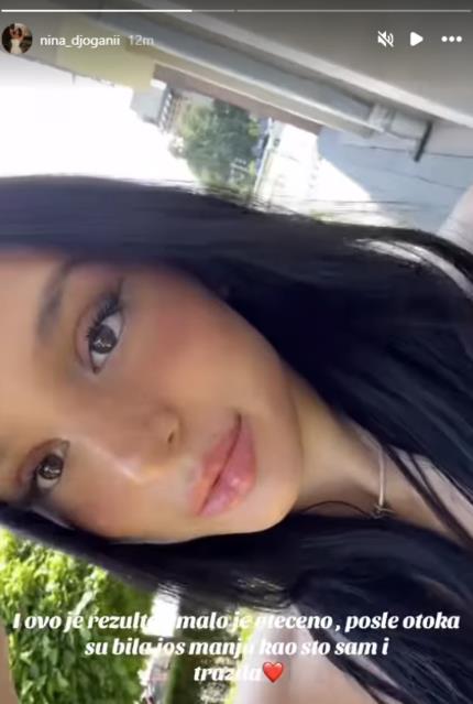 Nina Đogani pokazala proces smanjivanja usana