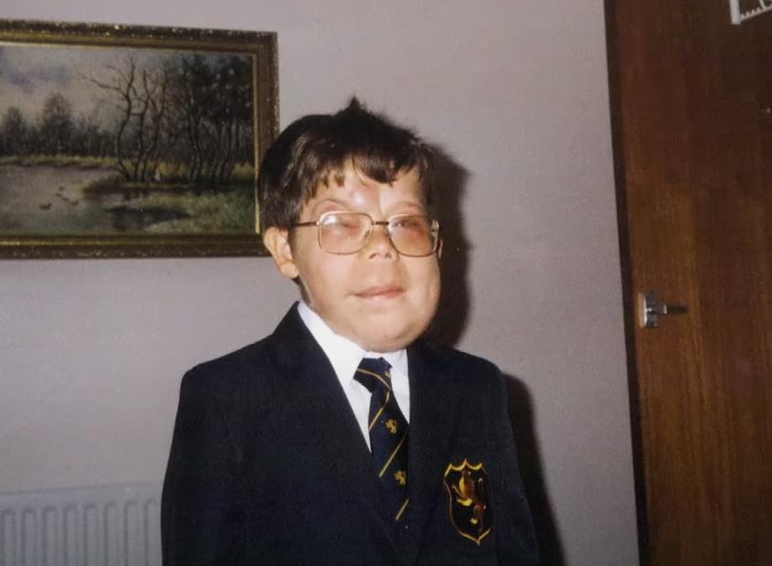 Još u detinjstvu počeli su da mu serazvijaju tumori na licu