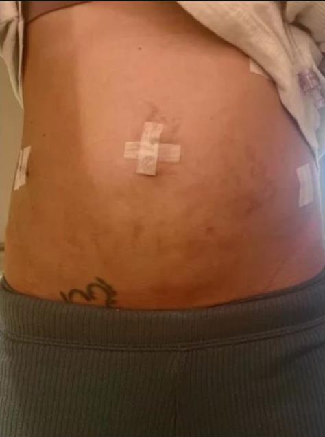 Laura Šefer pokazala svoj stomak nakon operacije.jpg