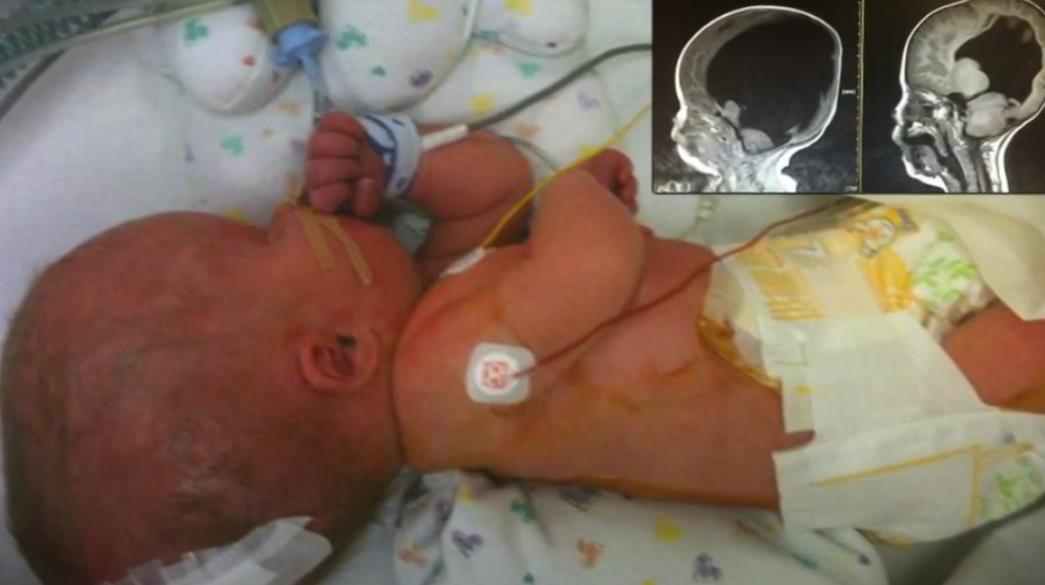 Noa Vol rođen sa 2% mozga, na rođenju imao veliku glavu