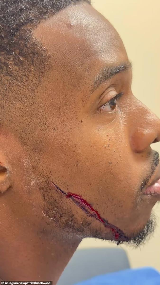 Patrik Blekvud nakon udara automobila u restoranu