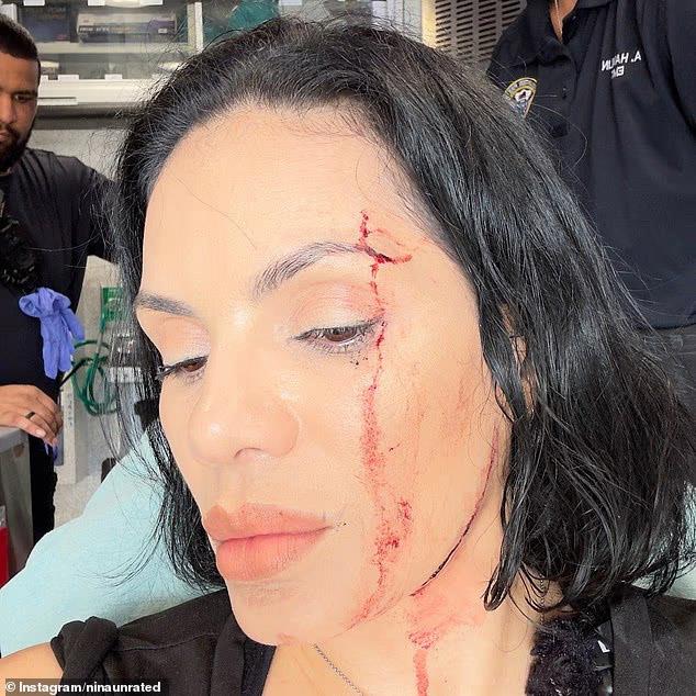 Nina Santjago krvava od udara automobila