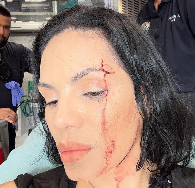 Nina Santjago krvava od udara automobila