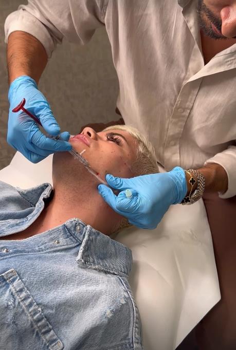 Uroš Stanić snimio proces estetskog zahvata na licu