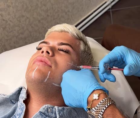 Uroš Stanić snimio proces estetskog zahvata na licu