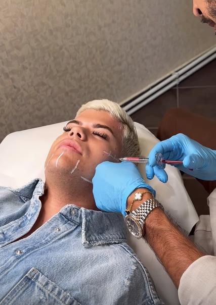 Uroš Stanić snimio proces estetskog zahvata na licu