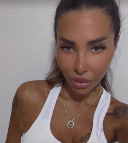 Aneli Ahmić pokazala lice nakon estetskih korekcija