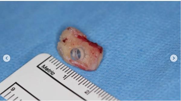 Oko od zuba Brenta Čepmena.jpg