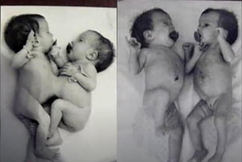 Sijamske bliznakinje Ana i Tanja Korkinova kao bebe.jpg